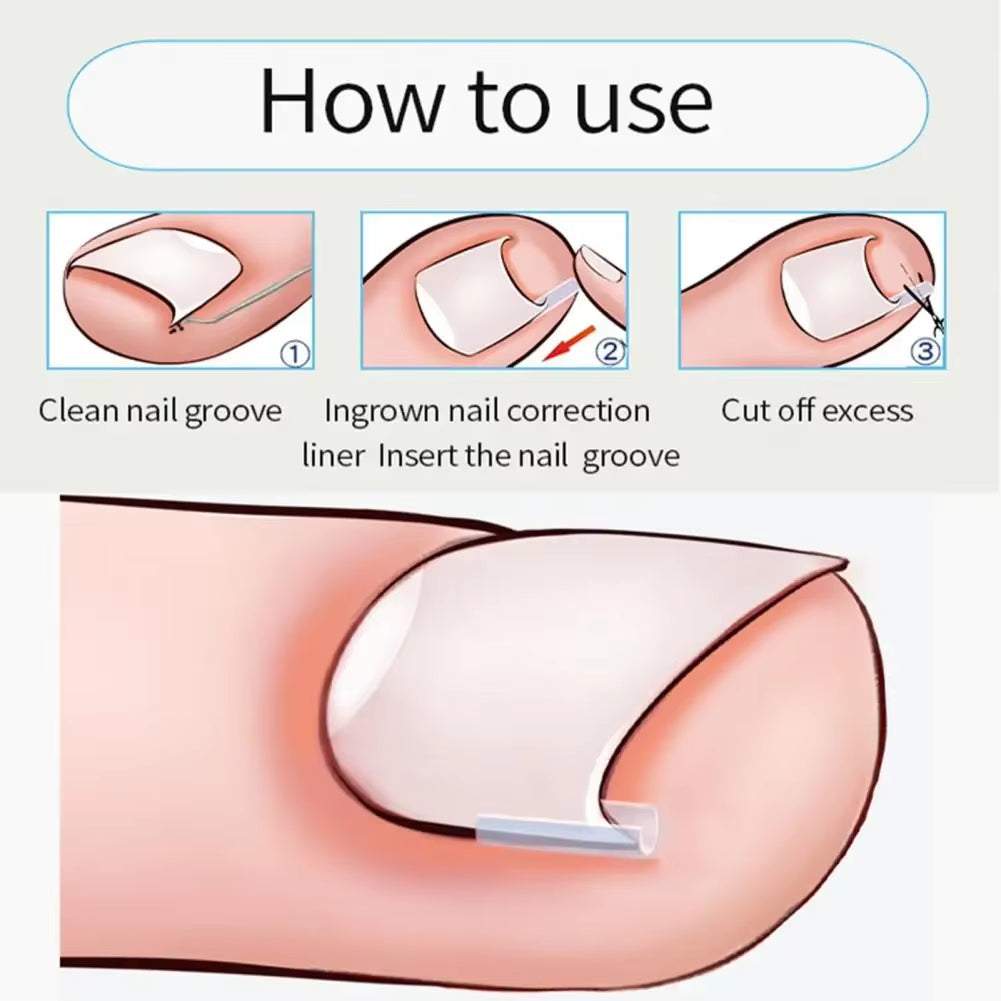 1-100PCS Ingrown Toenail Correction Ultra-Thin Nail Treatment Elastic Patch Sticker Straightening Nails Groove Ingrown Corrector