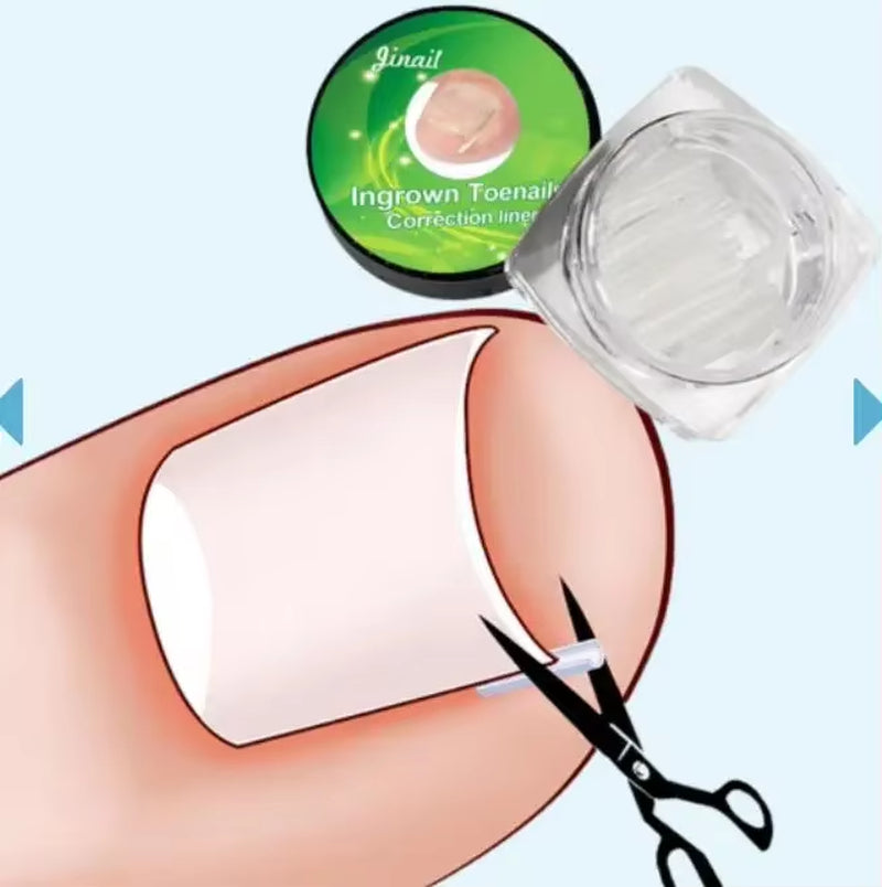 1-100PCS Ingrown Toenail Correction Ultra-Thin Nail Treatment Elastic Patch Sticker Straightening Nails Groove Ingrown Corrector