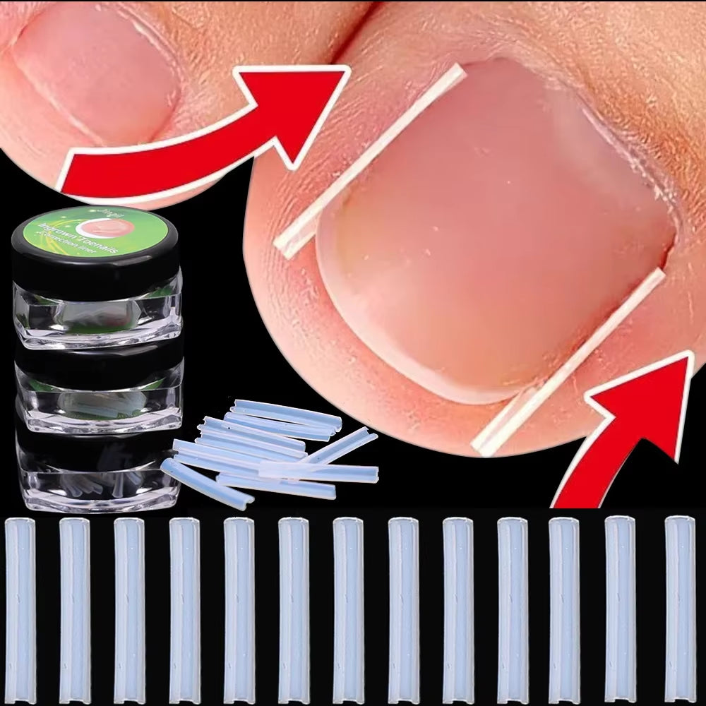 1-100PCS Ingrown Toenail Correction Ultra-Thin Nail Treatment Elastic Patch Sticker Straightening Nails Groove Ingrown Corrector